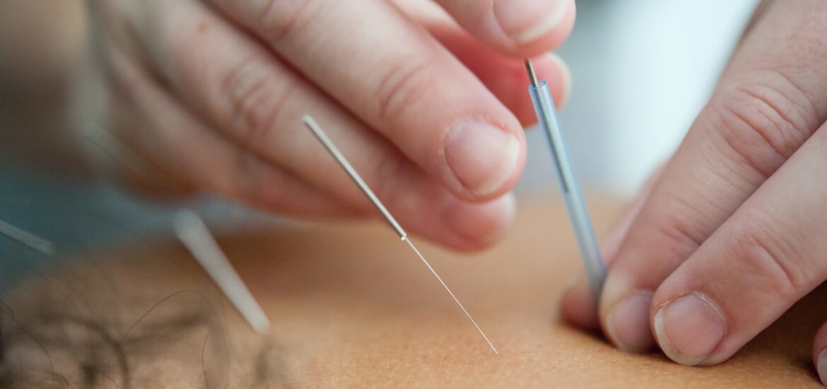 Acupuncture in IBS